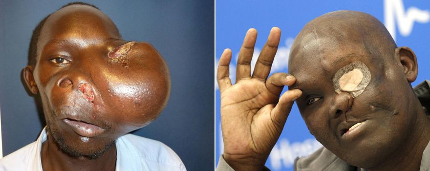 Imágenes de Mike Koech antes y después de someterse a las intervenciones.