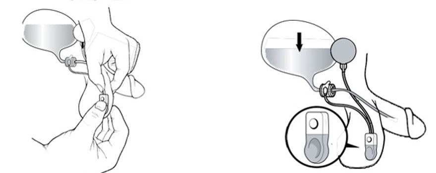 Imagen explicativa de cómo funciona el dispositivo implantado. 