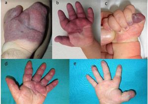 Imagens de miembros afectados por el síndrome.