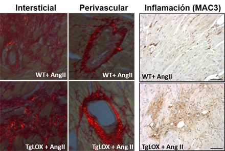 En el miocardio de los ratones transgénicos para la lisil oxidasa (TgLOX), la administración de Angiotensina II (AngII) aumenta el nivel de colágeno maduro (visualizado como refringencia roja) frente a los animales normales (WT). Los animales transgénicos presentan además mayor inflamación (paneles de la derecha). Imagen: Cibercv.