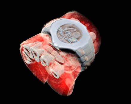 Imagen de una radiografía a color de una muñeca.