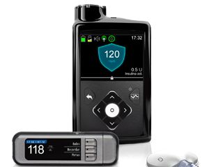 Sistema híbrido de asa cerrada para diabetes tipo 1 fabricado por Medtronic.