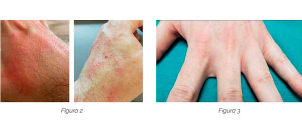 A la izquierda, un eczema irritativo de contacto. A la derecha, reacción inflamatoria en los pliegues interdigitales.