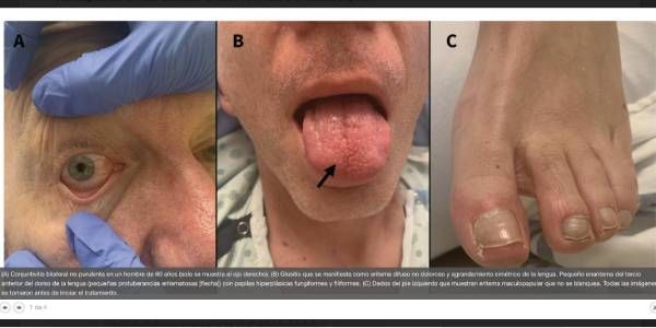 (A) Conjuntivitis bilateral no purulenta en un hombre de 60 años (solo se muestra el ojo derecho). (B) Glositis que se manifiesta como eritema difuso no doloroso y agrandamiento simétrico de la lengua. Pequeño enantema del tercio anterior del dorso de la lengua (pequeñas protuberancias eritematosas [flecha]) con papilas hiperplásicas fungiformes y filiformes. (C) Dedos del pie izquierdo que muestran eritema maculopapular que no se blanquea. Todas las imágenes se tomaron antes de iniciar el tratamiento. Fuente: Canadian Medical Association Journal.