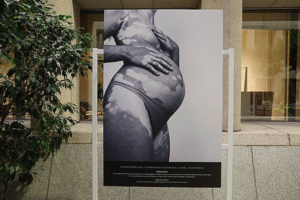 Fotografía ganadora del certamen realizado por la primera exposición fotográfica dedicada al vitíligo.
