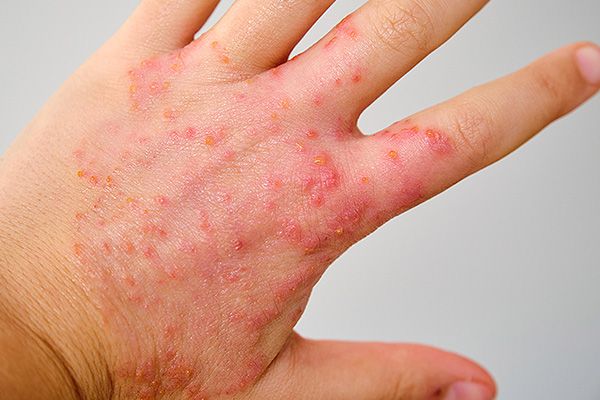 Según la Organización Mundial de la Salud, el sarampión es una enfermedad febril que suele aparecer entre los 10 y 14 días después de la exposición del virus.